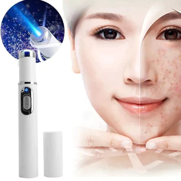 Caneta Laser Anti Acne e Varizes - Elimine as varizes e a acne de forma eficiente!